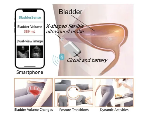 Research Team Develops Deep Learning AI with Ultrasonic Sensors to Alert Urinary Tract Dysfunction Patients of Abnormal Bladder Activity