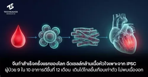 China Achieves World's First: Heart Muscle Cell Transplant from iPSC Shows 90% Improvement in Heart Failure Patients at 12 Months